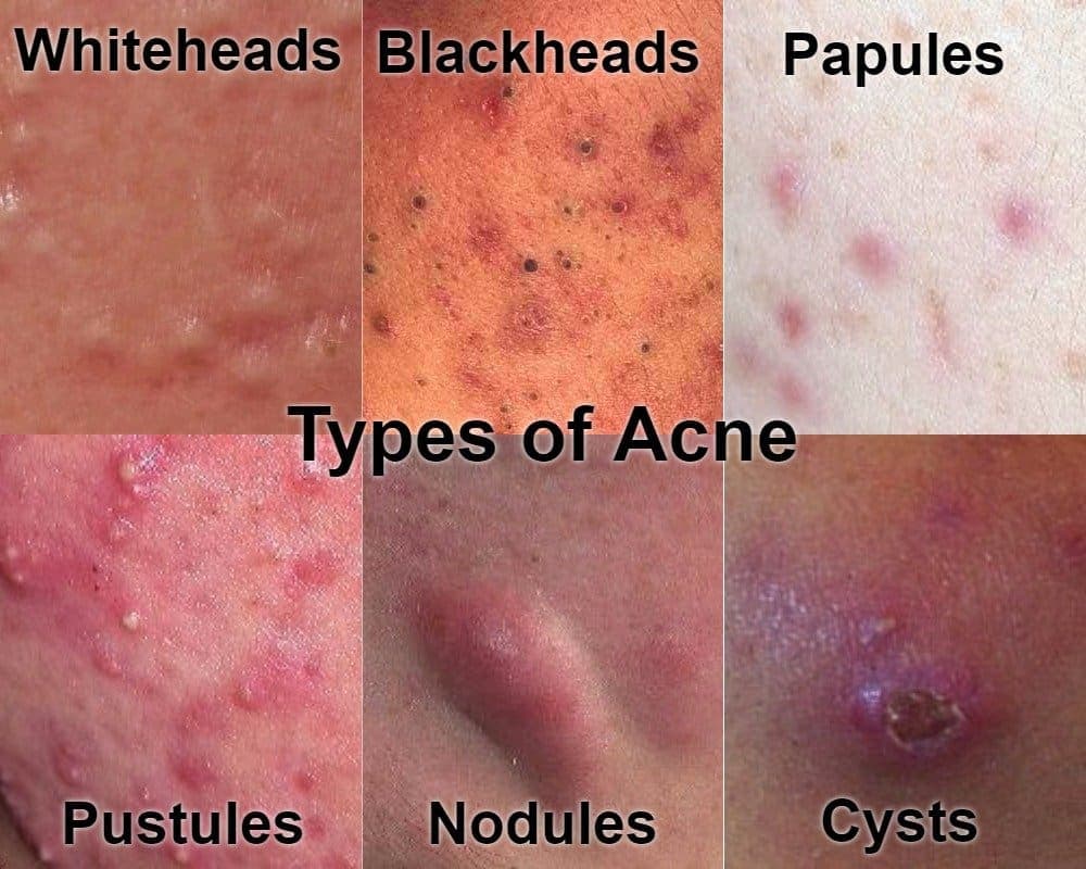 Types of acne — whiteheads, blackheads, papules, pustules, nodules and cysts
