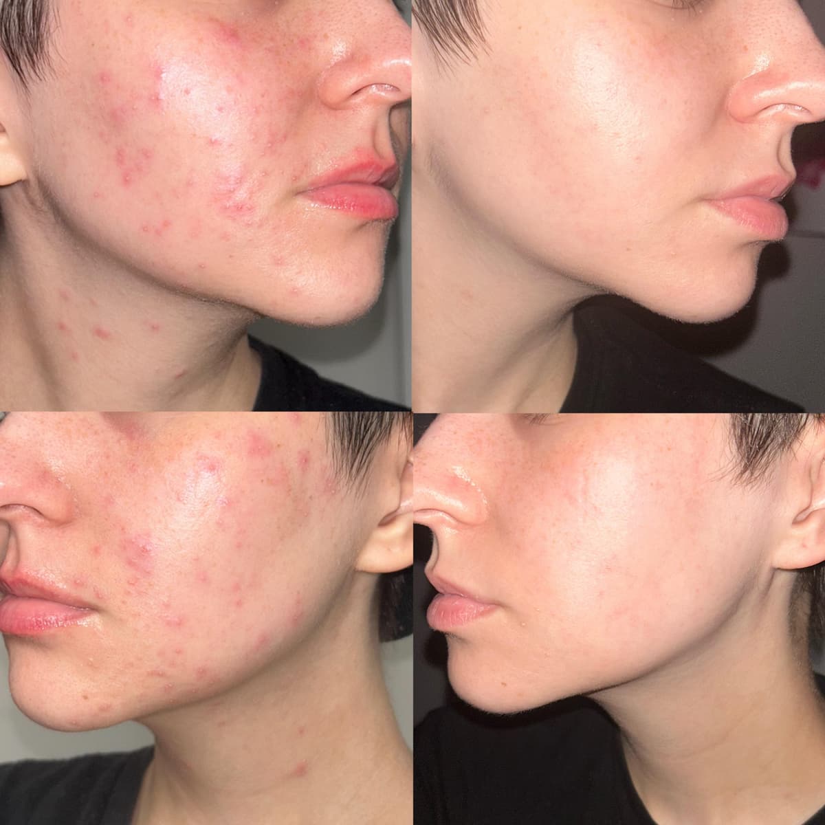 Before and after skin clearing results