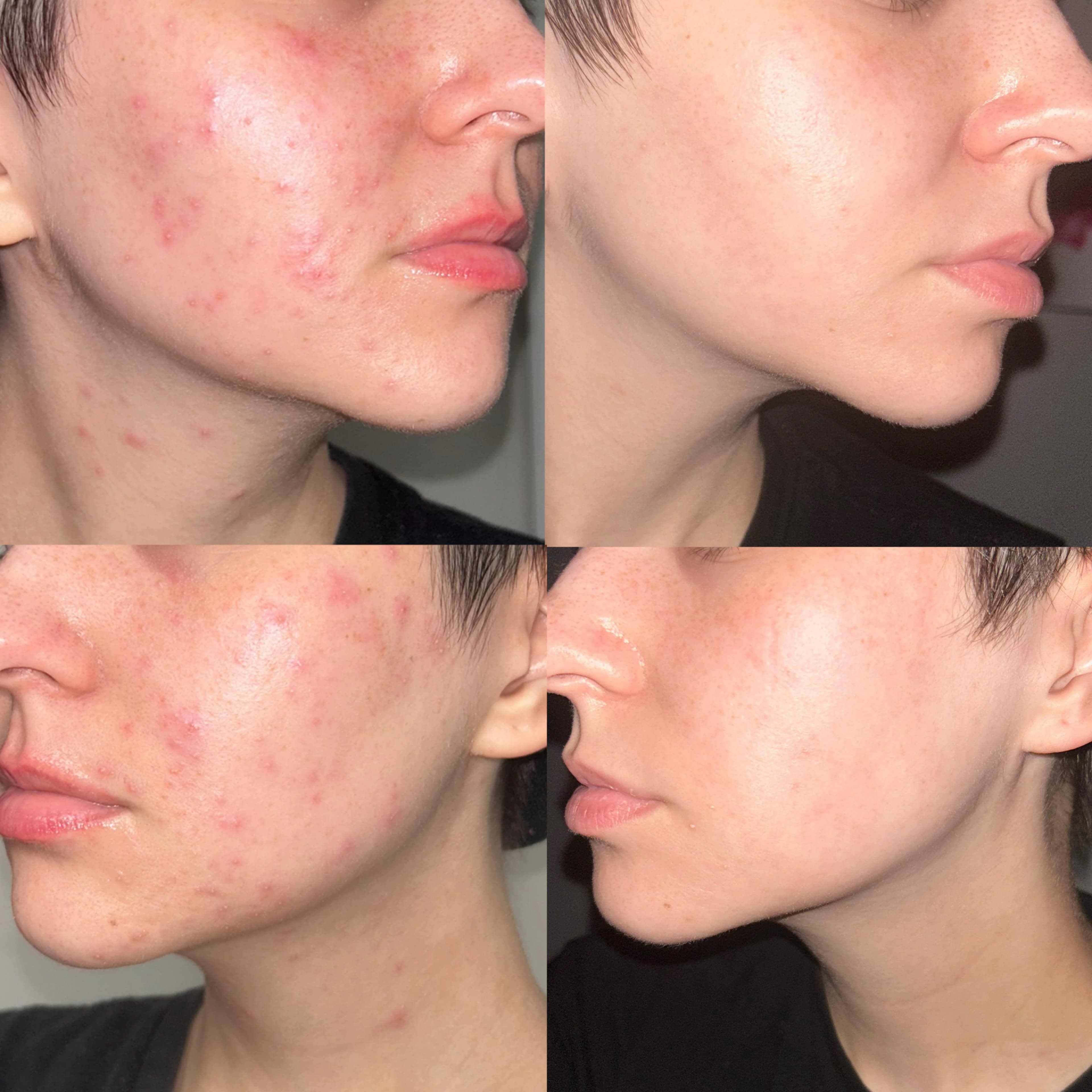 Aesthetic treatment for acne-related skin texture
