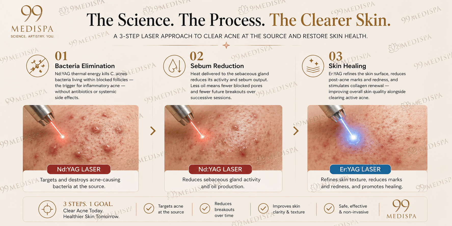 Twinlight Acne 3-step laser approach — bacteria elimination, sebum reduction, skin healing