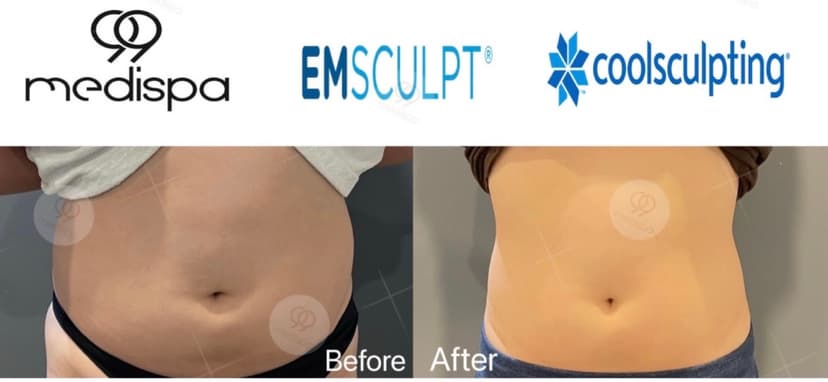 Before and after of EMSCULPT and CoolSculpting