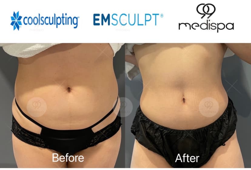 Before and after of EMSCULPT and CoolSculpting