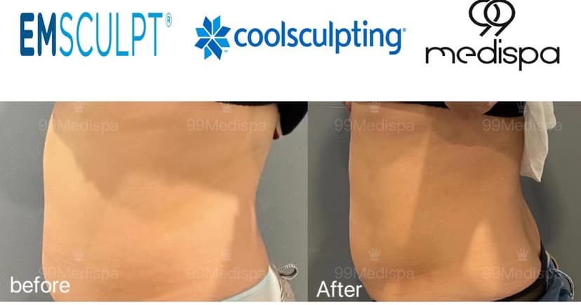 Before and after of EMSCULPT and CoolSculpting