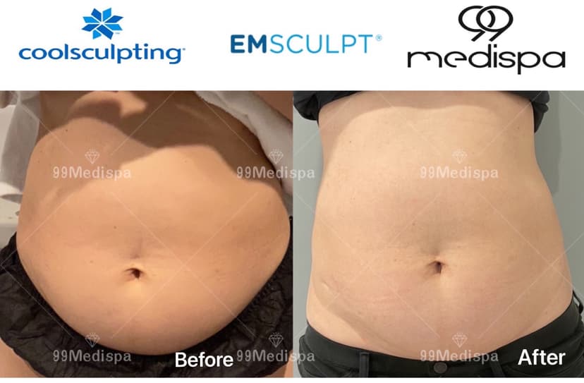 Before and after of EMSCULPT and CoolSculpting