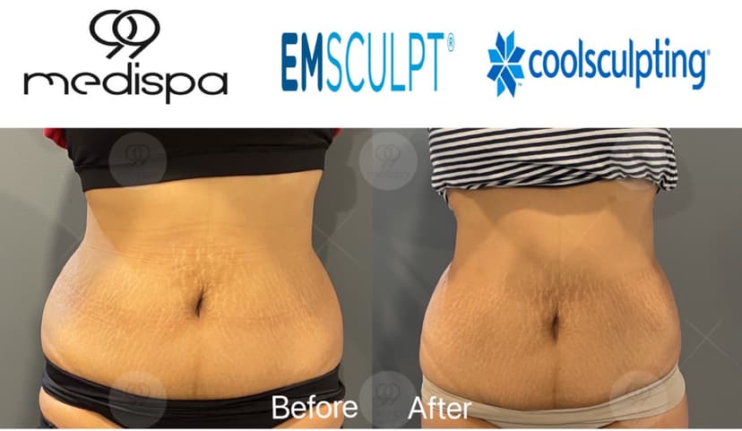 Before and after of EMSCULPT and CoolSculpting
