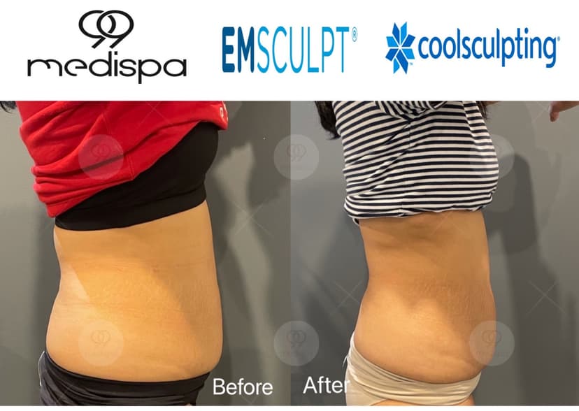 Before and after of EMSCULPT and CoolSculpting