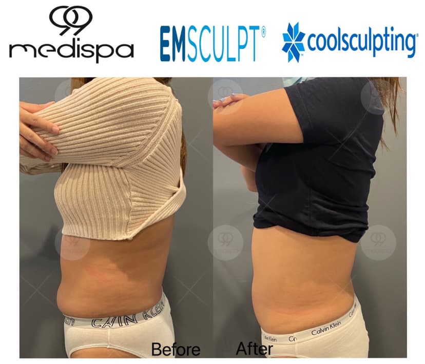 Before and after of EMSCULPT and CoolSculpting