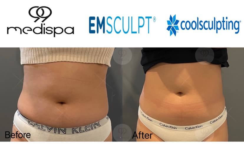 Before and after of EMSCULPT and CoolSculpting