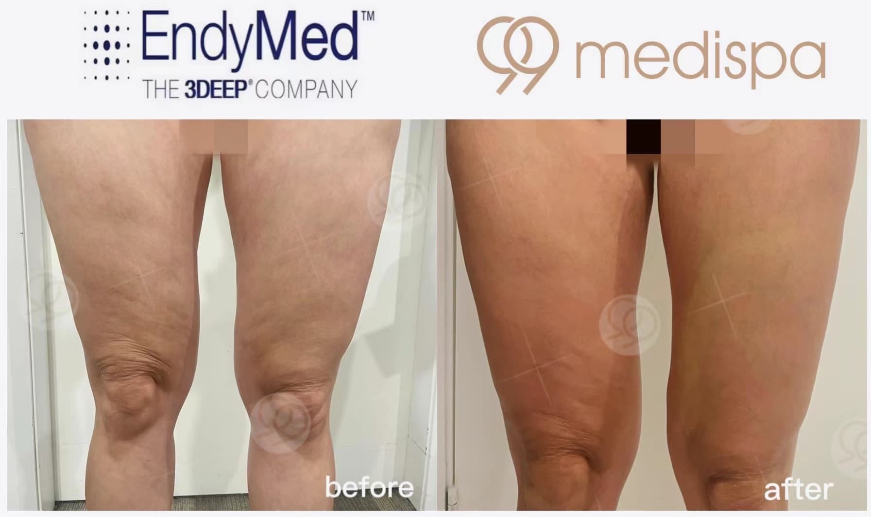 Stretch mark and cellulite treatment at 99 Medispa Sydney