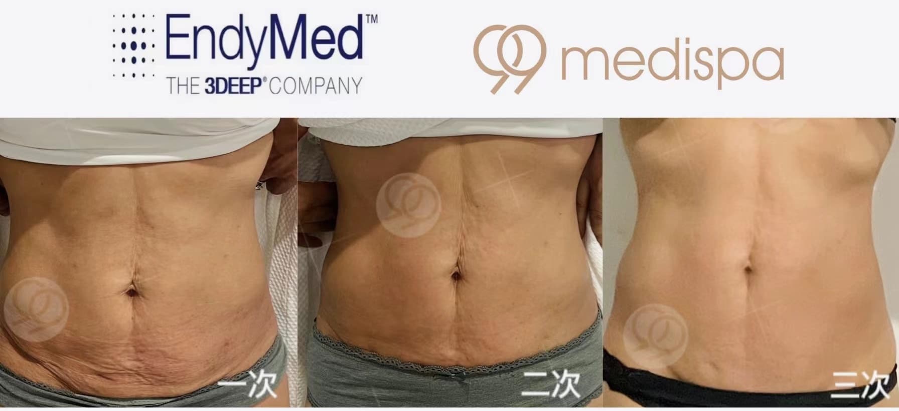 Before and after EndyMed skin treatment result 2