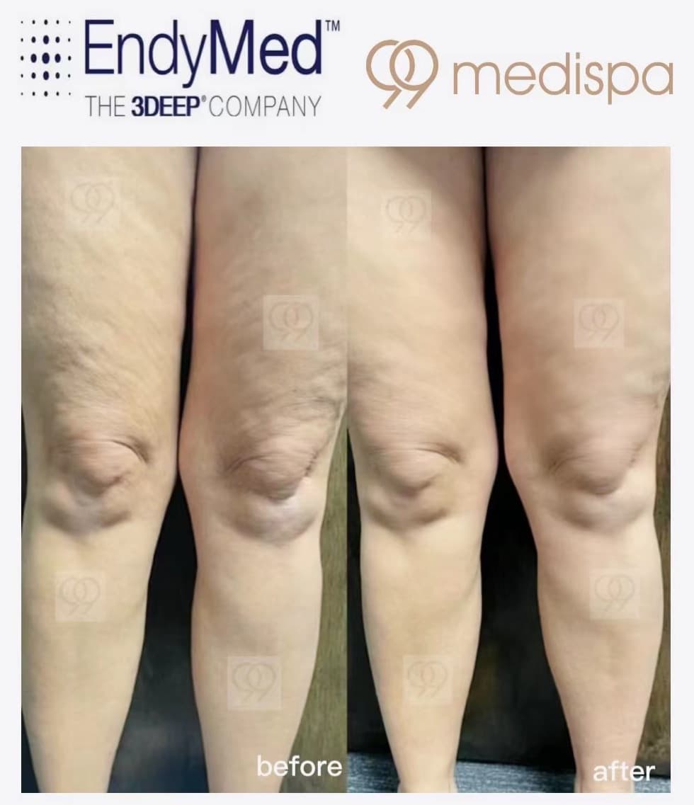 Before and after EndyMed skin treatment result 3