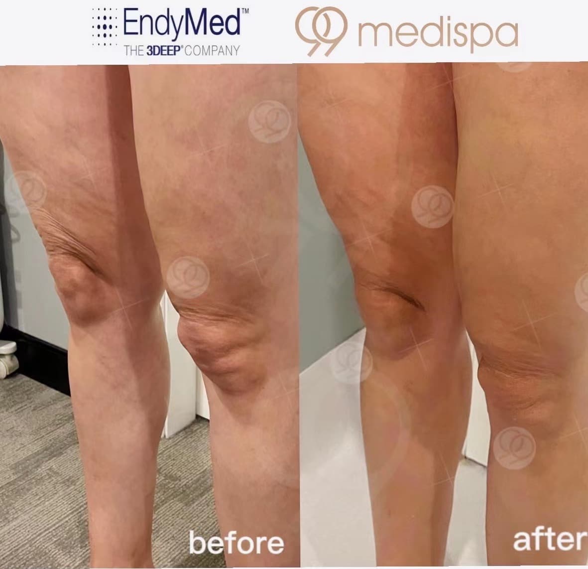 Before and after EndyMed skin treatment result 4