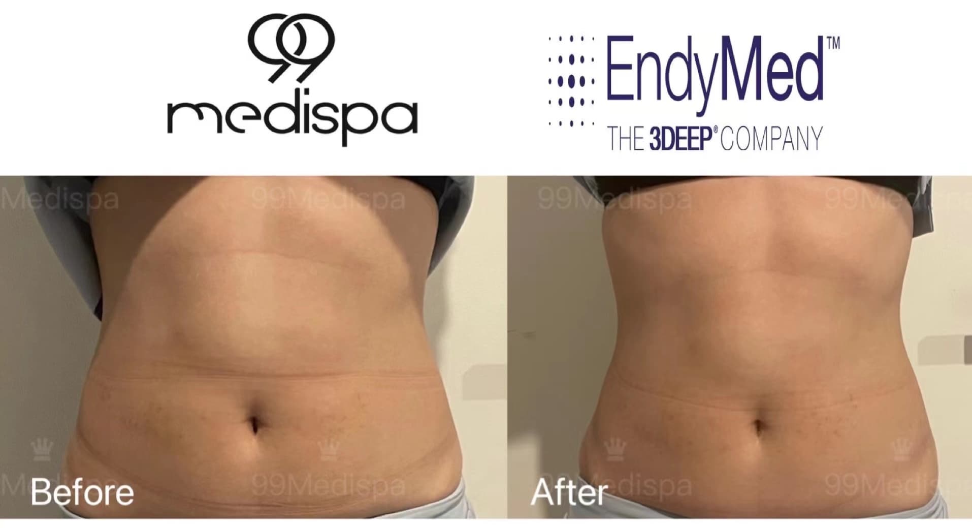 Before and after EndyMed skin treatment result 5