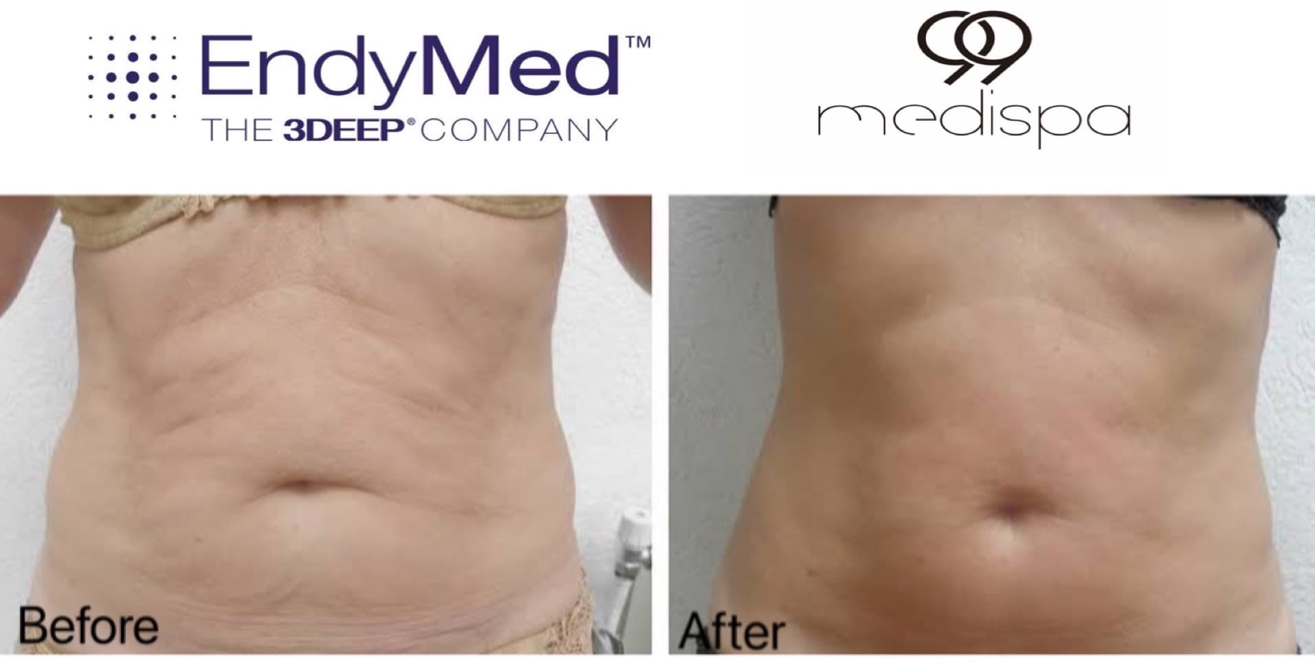 Before and after EndyMed skin treatment result 6