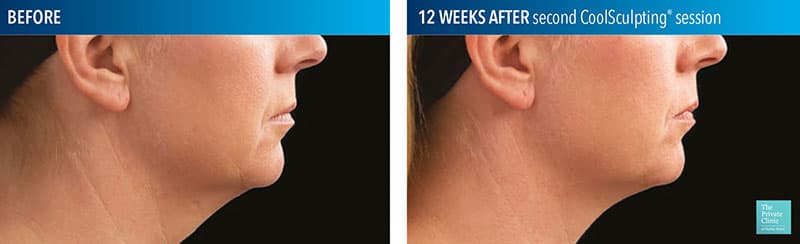 CoolSculpting CoolMini before and after — double chin fat reduction
