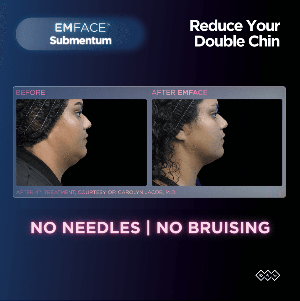 EMFACE double chin before and after — female patient