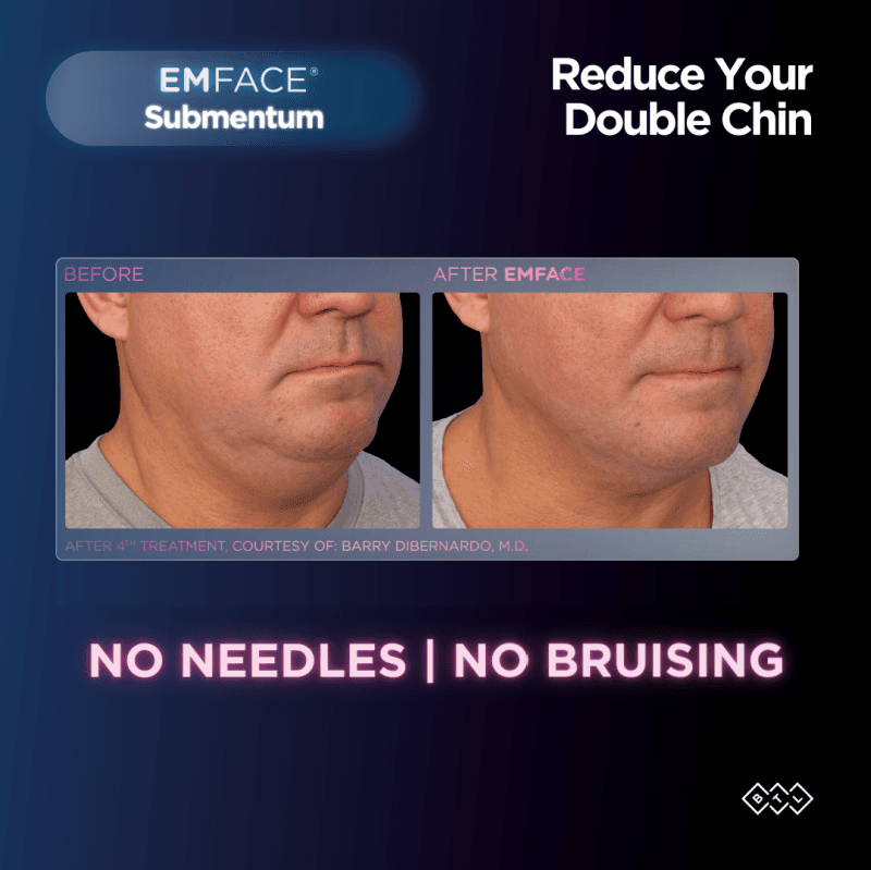 EMFACE double chin before and after — male patient