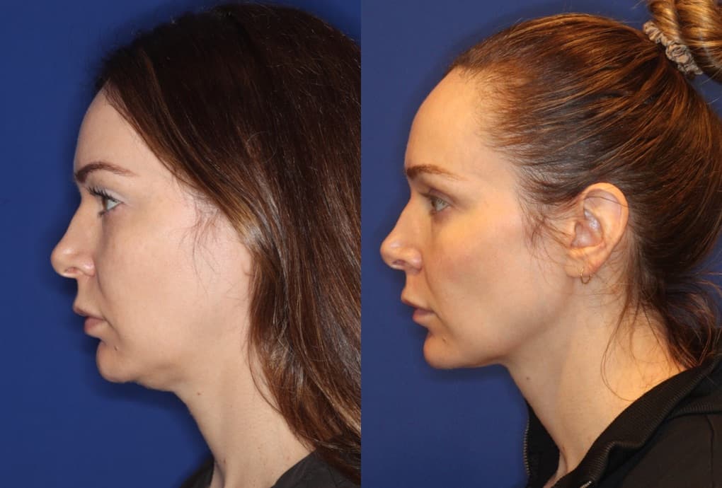 EMFACE Chin before and after — submental muscle toning and definition