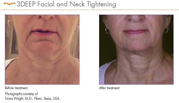 EndyMed RF before and after — submental skin tightening