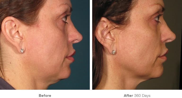 Ultherapy before and after — double chin and jawline tightening