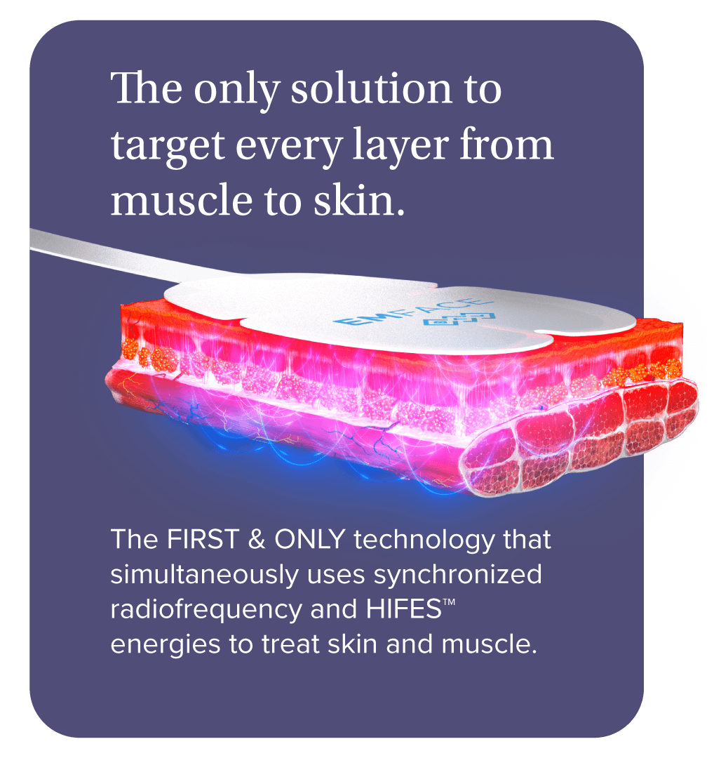 EMFACE muscle layer diagram — HIFES stimulation of facial muscles