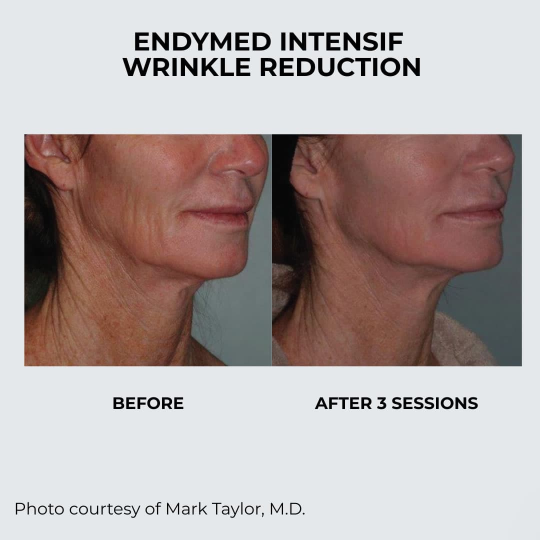 Before and after EndyMed Intensif wrinkle reduction — jawline and neck after 3 sessions