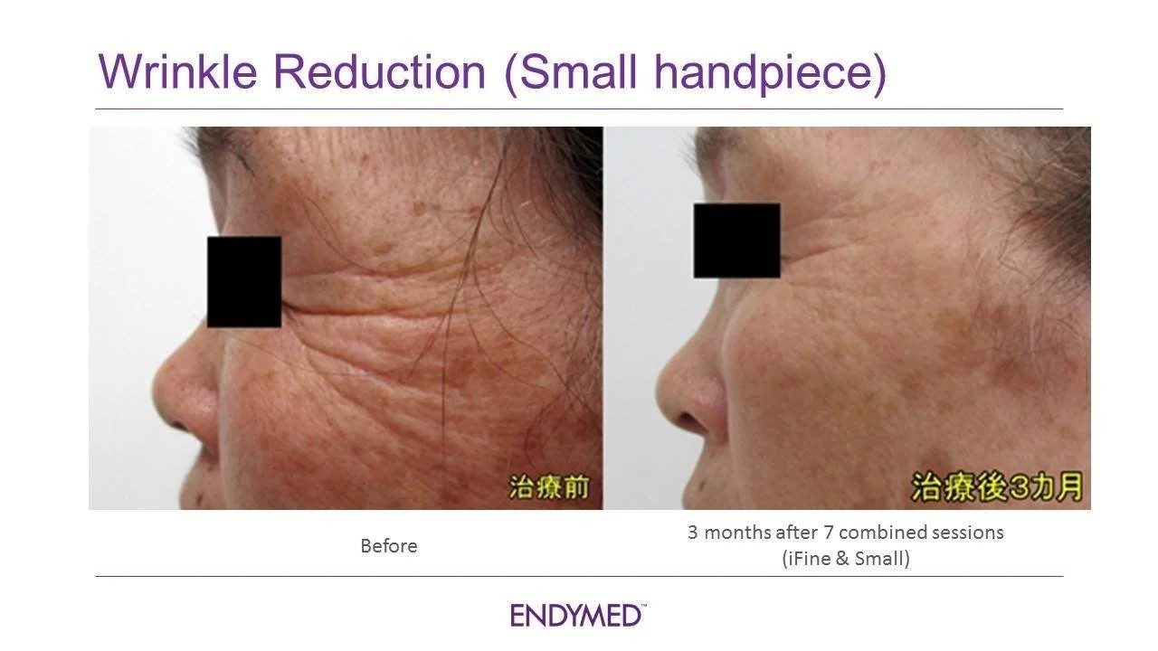 Before and after EndyMed wrinkle reduction — crow's feet and facial lines after 7 sessions