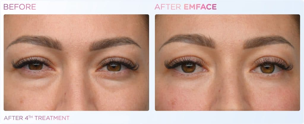 EMFACE Eyes before and after — periorbital lifting and crow's feet reduction