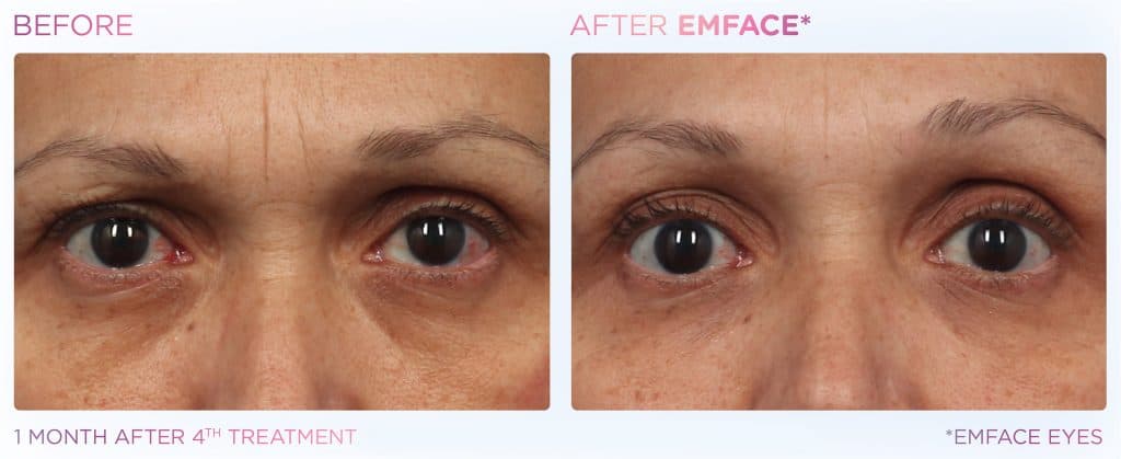EMFACE Eyes before and after — under-eye tightening