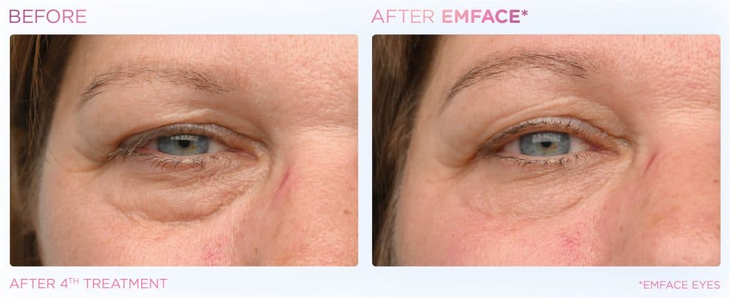 EMFACE Eyes before and after — crow's feet and eyelid laxity