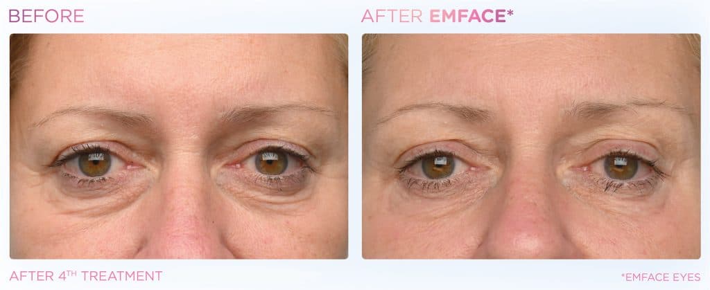 EMFACE Eyes before and after — periorbital skin tightening