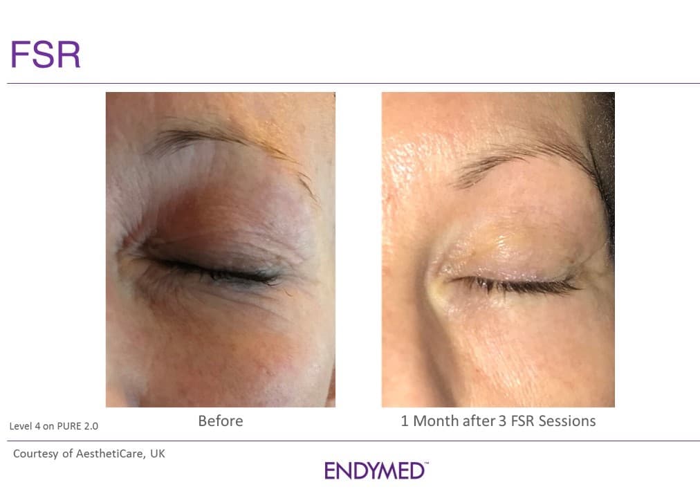 EndyMed FSR before and after — eye area skin resurfacing and tightening