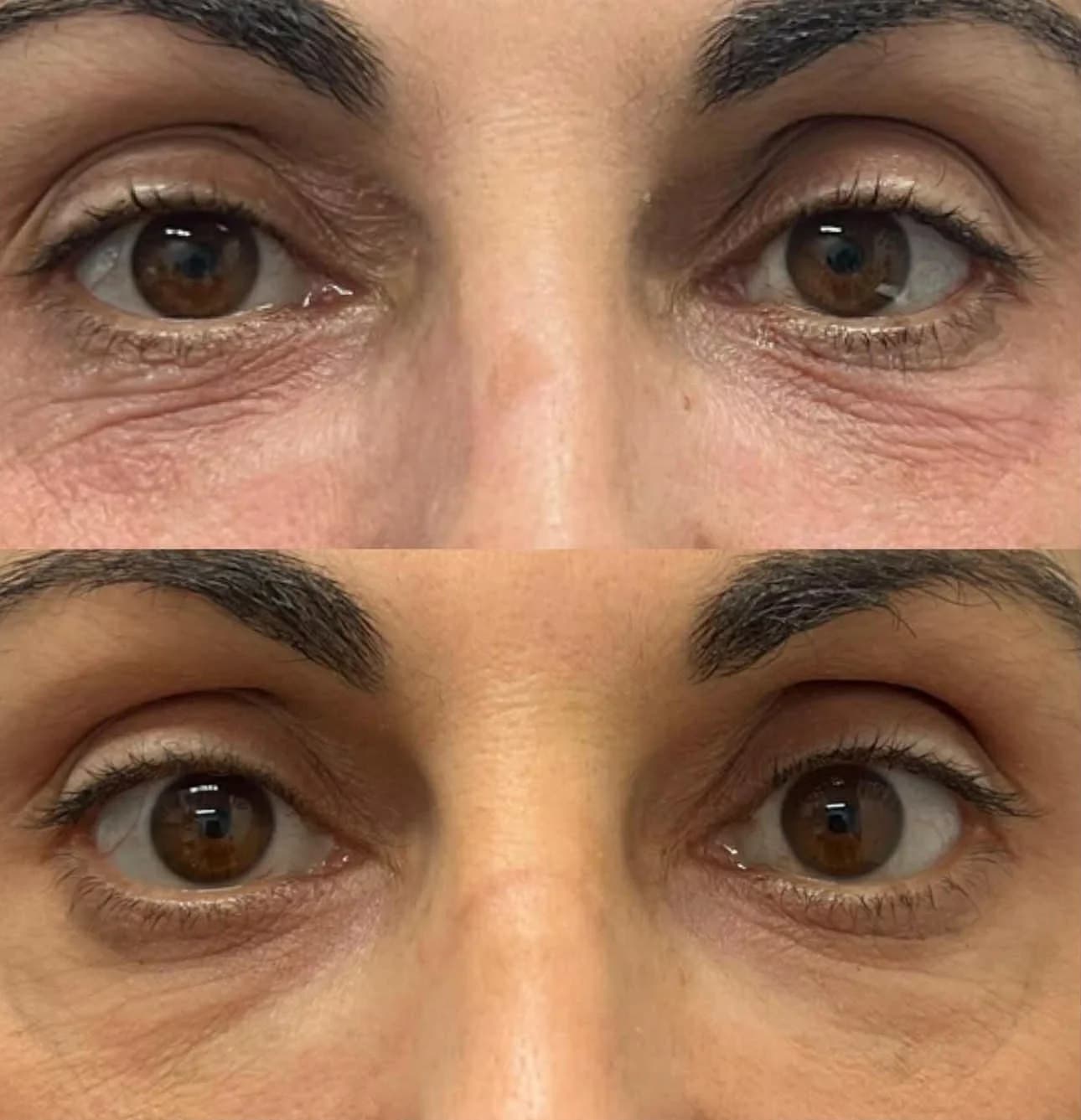Rejuran skin booster before and after — under-eye hydration and skin quality