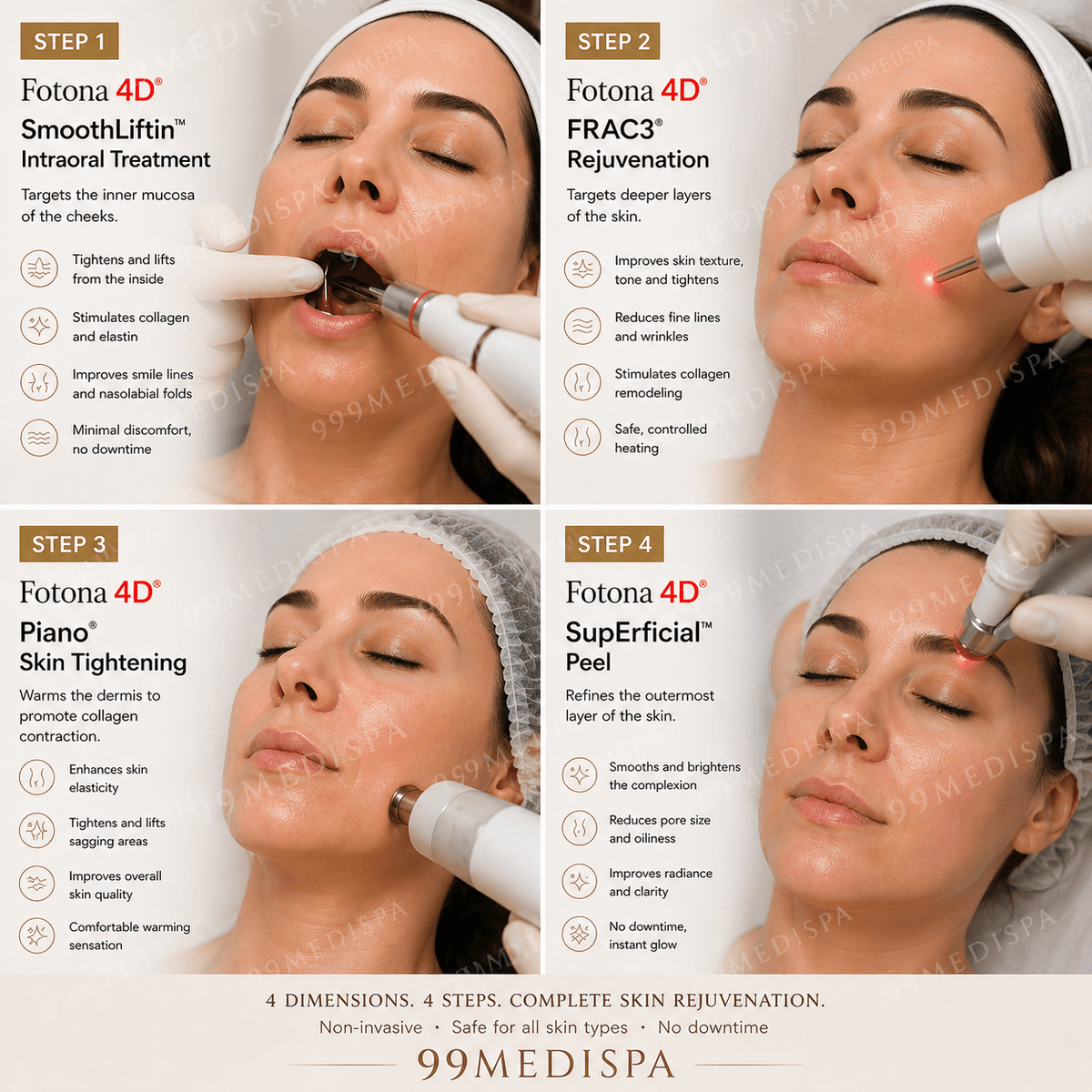 Fotona 4D intraoral laser treatment for facial hollowness