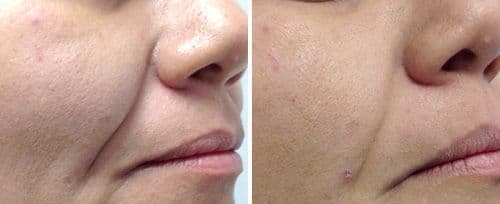 Before and after Fotona4D skin resurfacing — cheek and nasolabial area