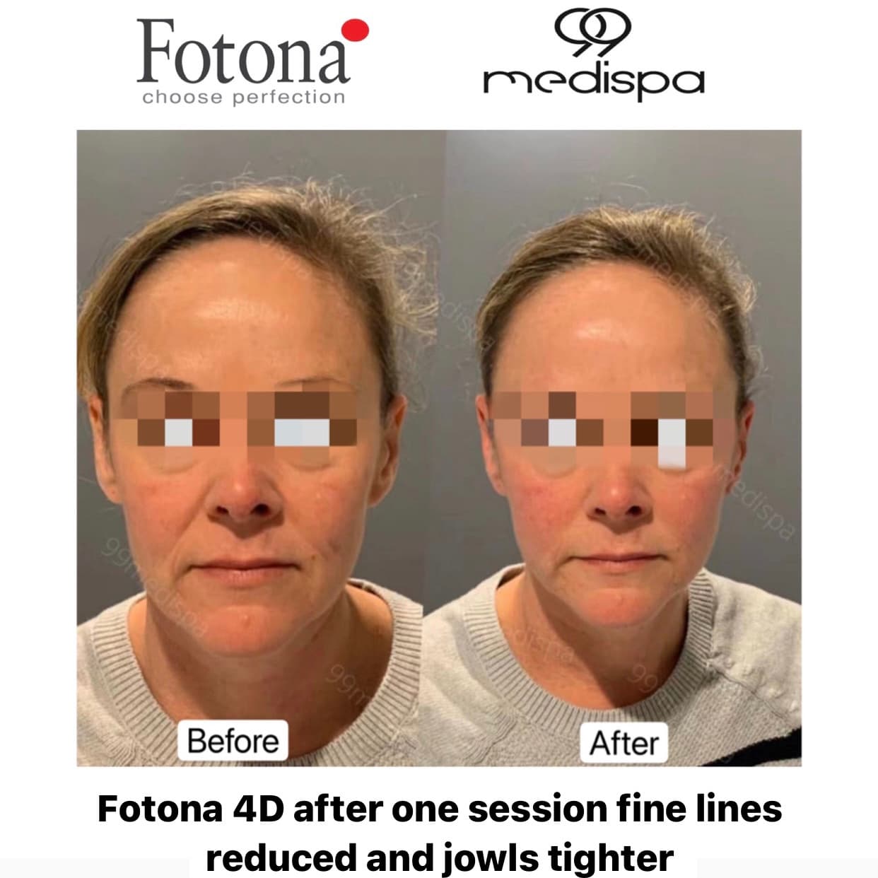 Before and after photo of Fotona treatment