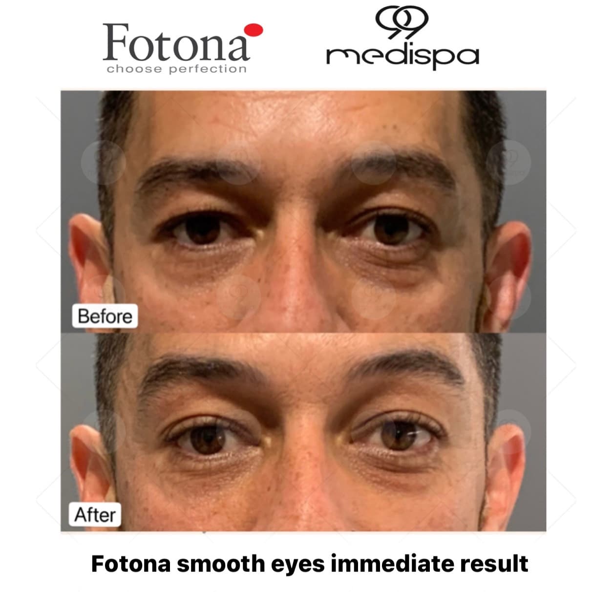 Before and after photo of Fotona treatment