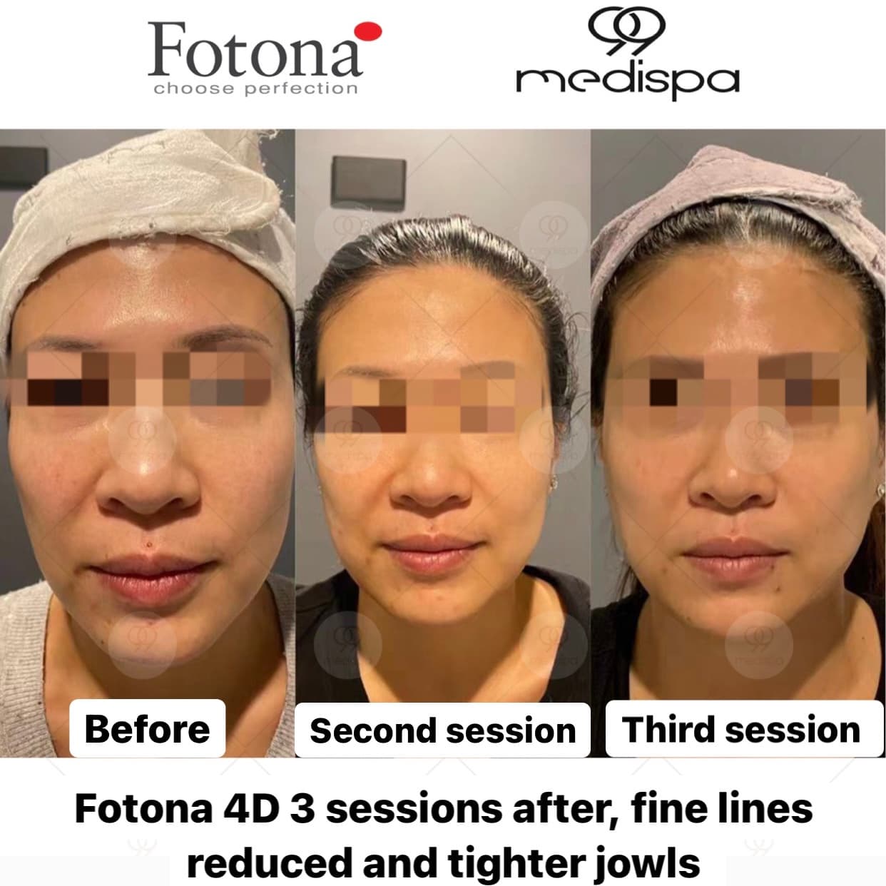 Before and after Fotona wrinkle treatment