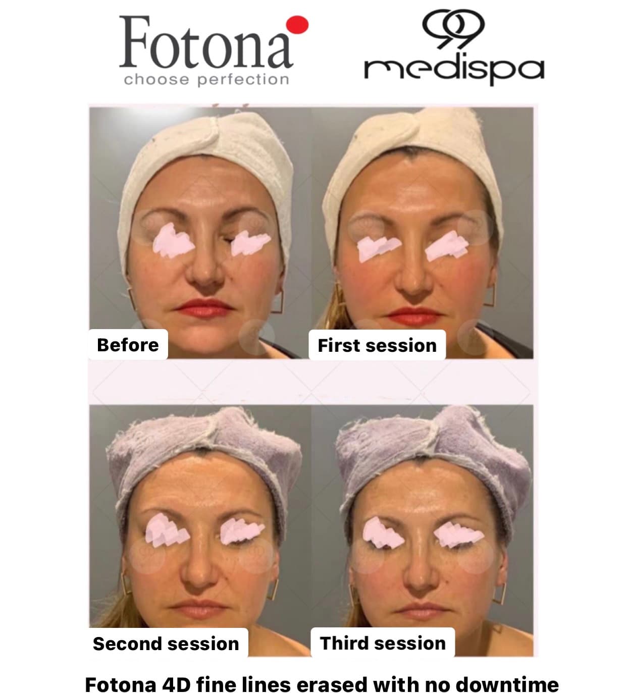 Before and after Fotona wrinkle treatment