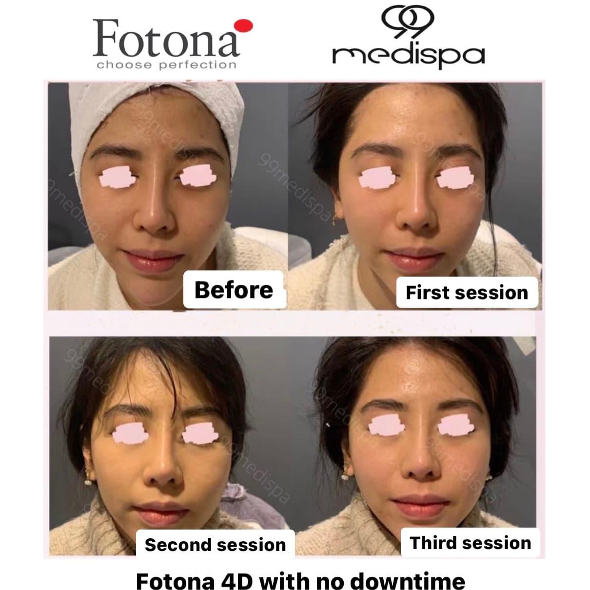 Before and after Fotona wrinkle treatment