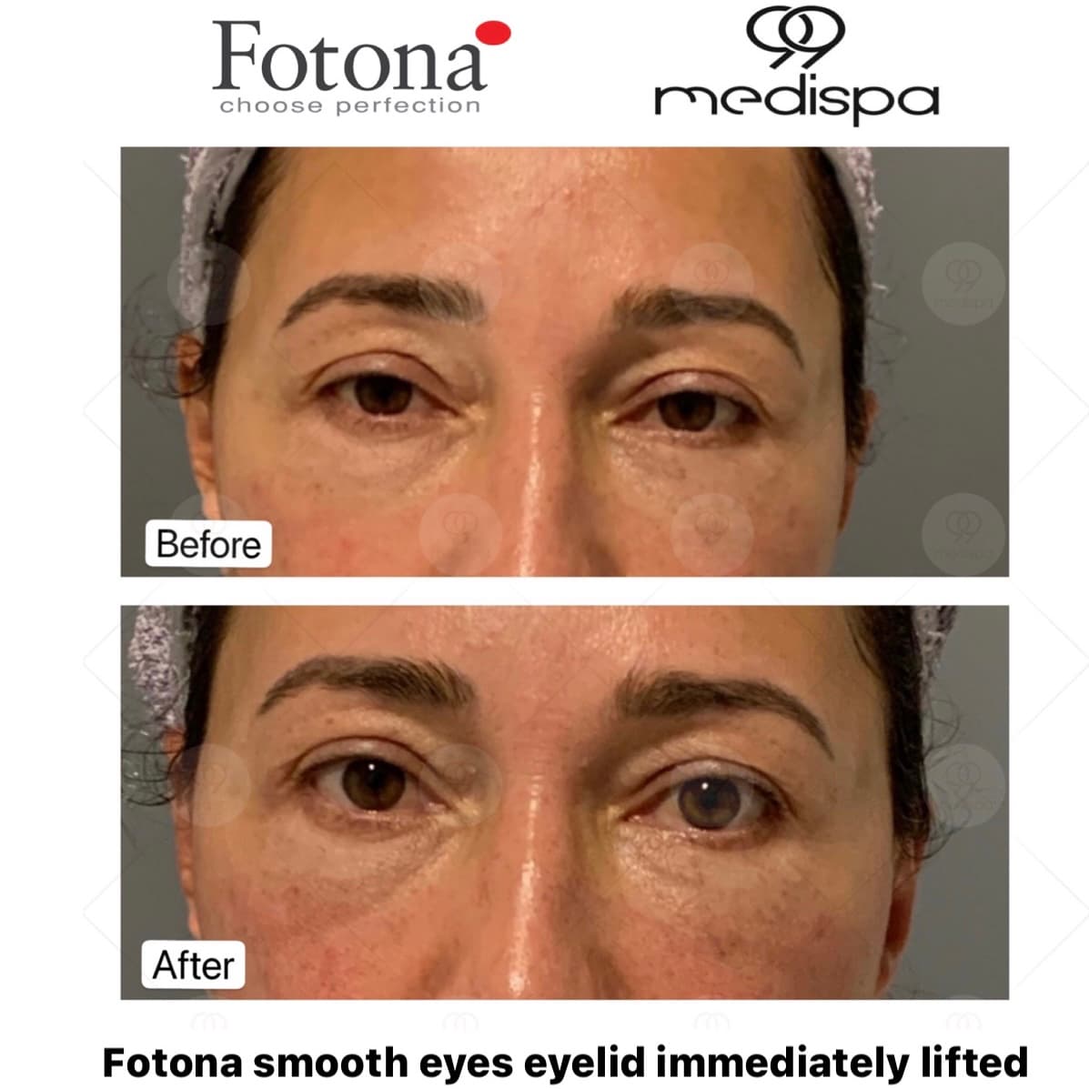 Before and after photo of Fotona treatment
