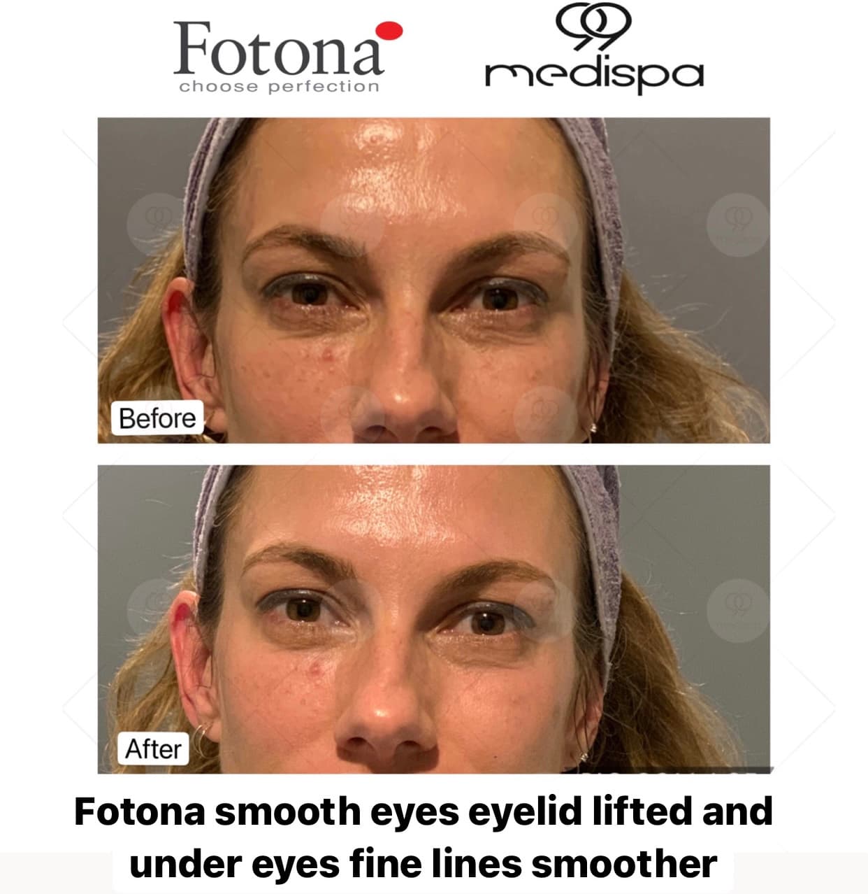 Before and after photo of Fotona treatment