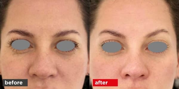 Fotona VectorLift before and after — brow lifting and upper eyelid tightening