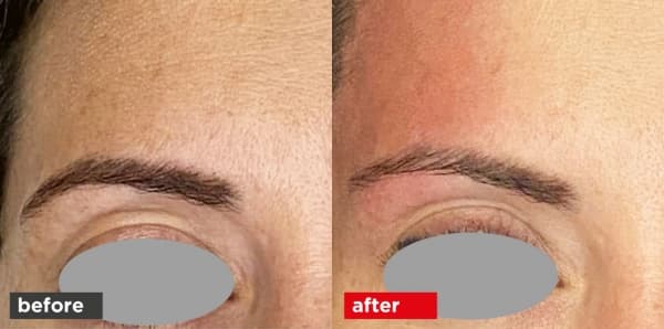 Fotona VectorLift before and after — eyebrow elevation results