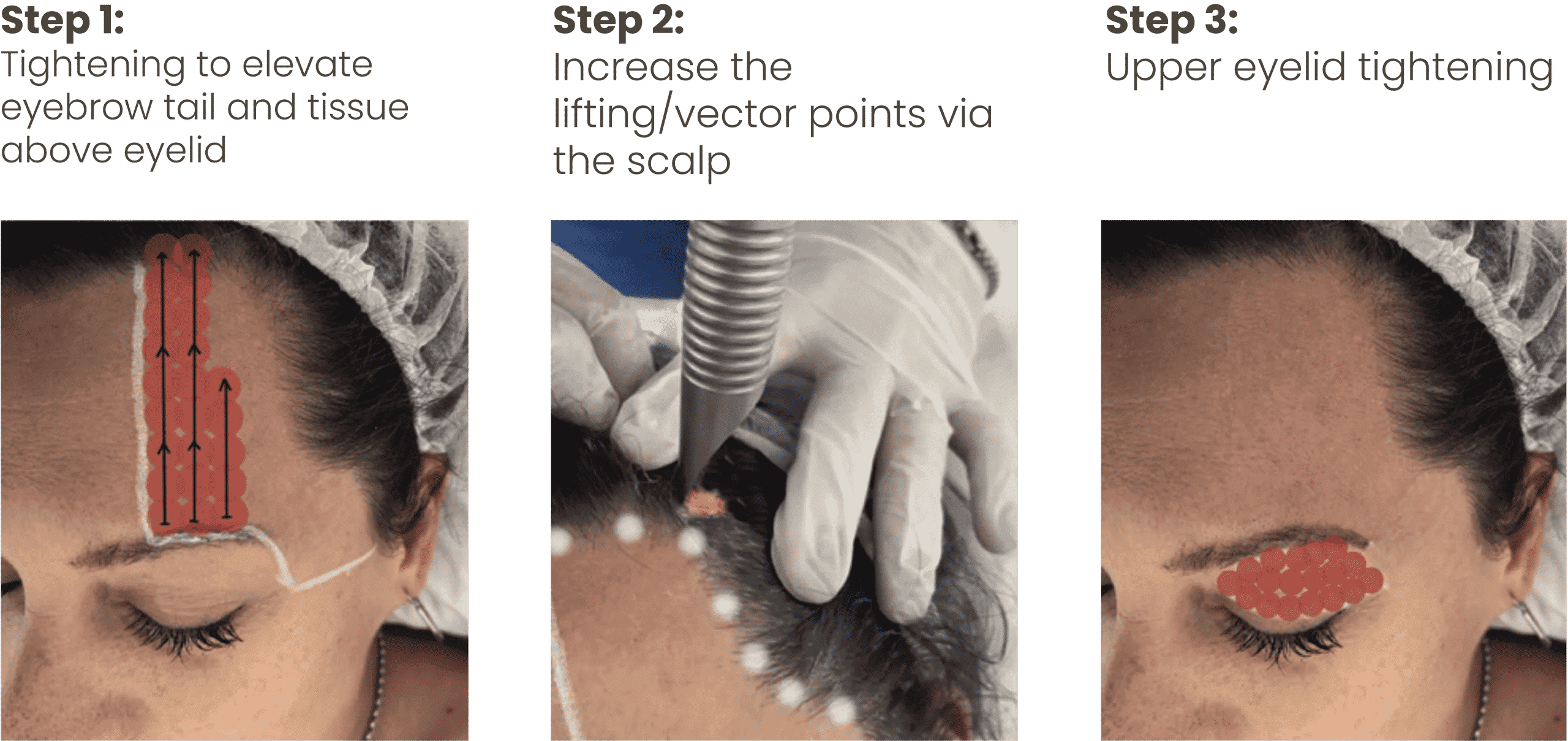 Fotona VectorLift 3-step protocol — eyebrow elevation, scalp anchor points, upper eyelid tightening
