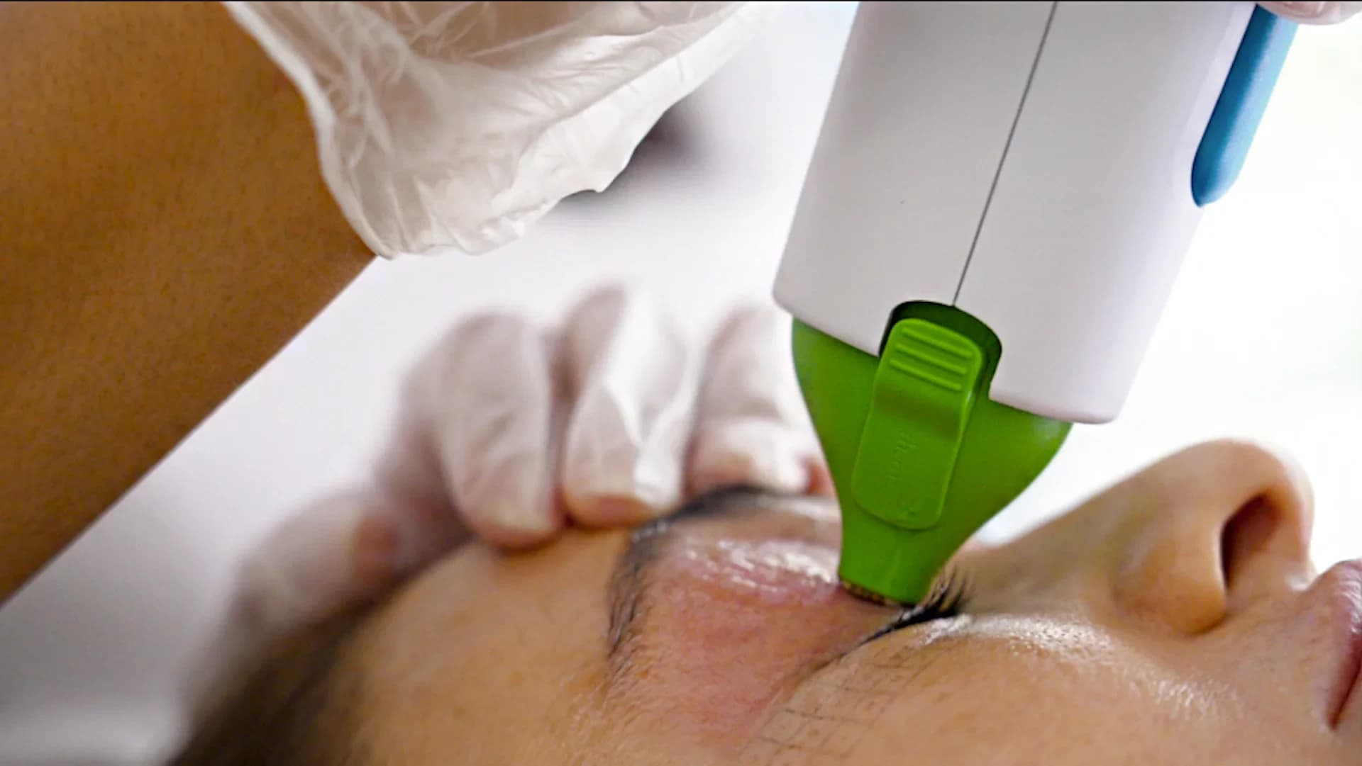 Thermage FLX Eyes radiofrequency treatment