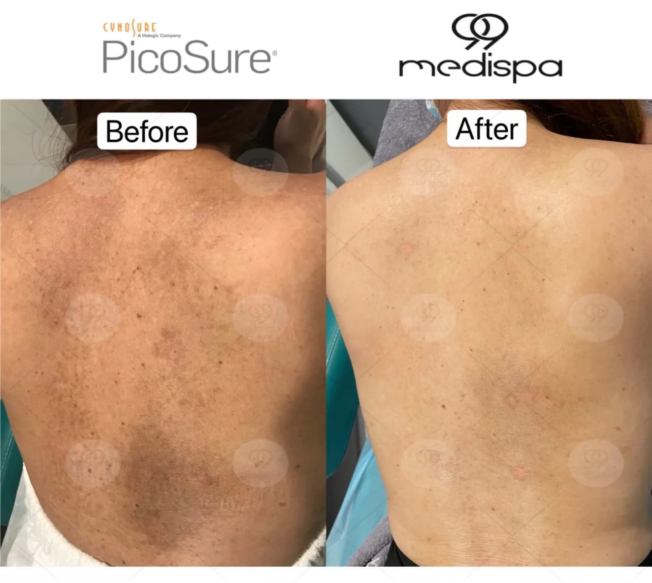 Picosure laser treatment result