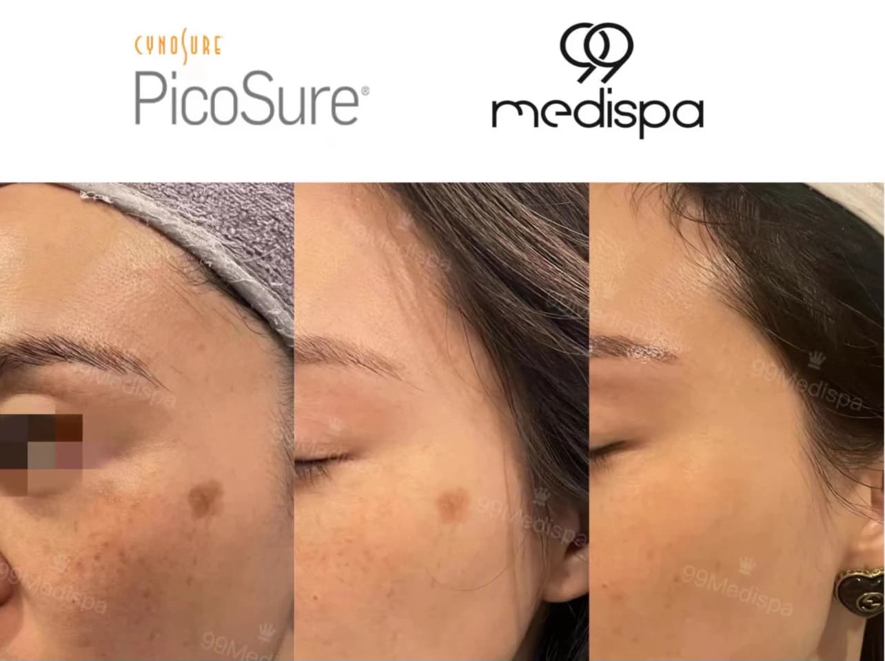 Before and after Picosure pigmentation treatment 2