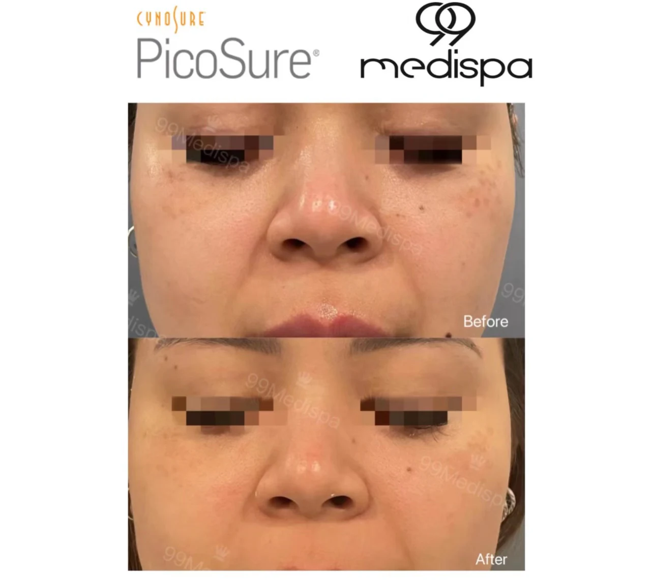 Before and after Picosure pigmentation treatment 4