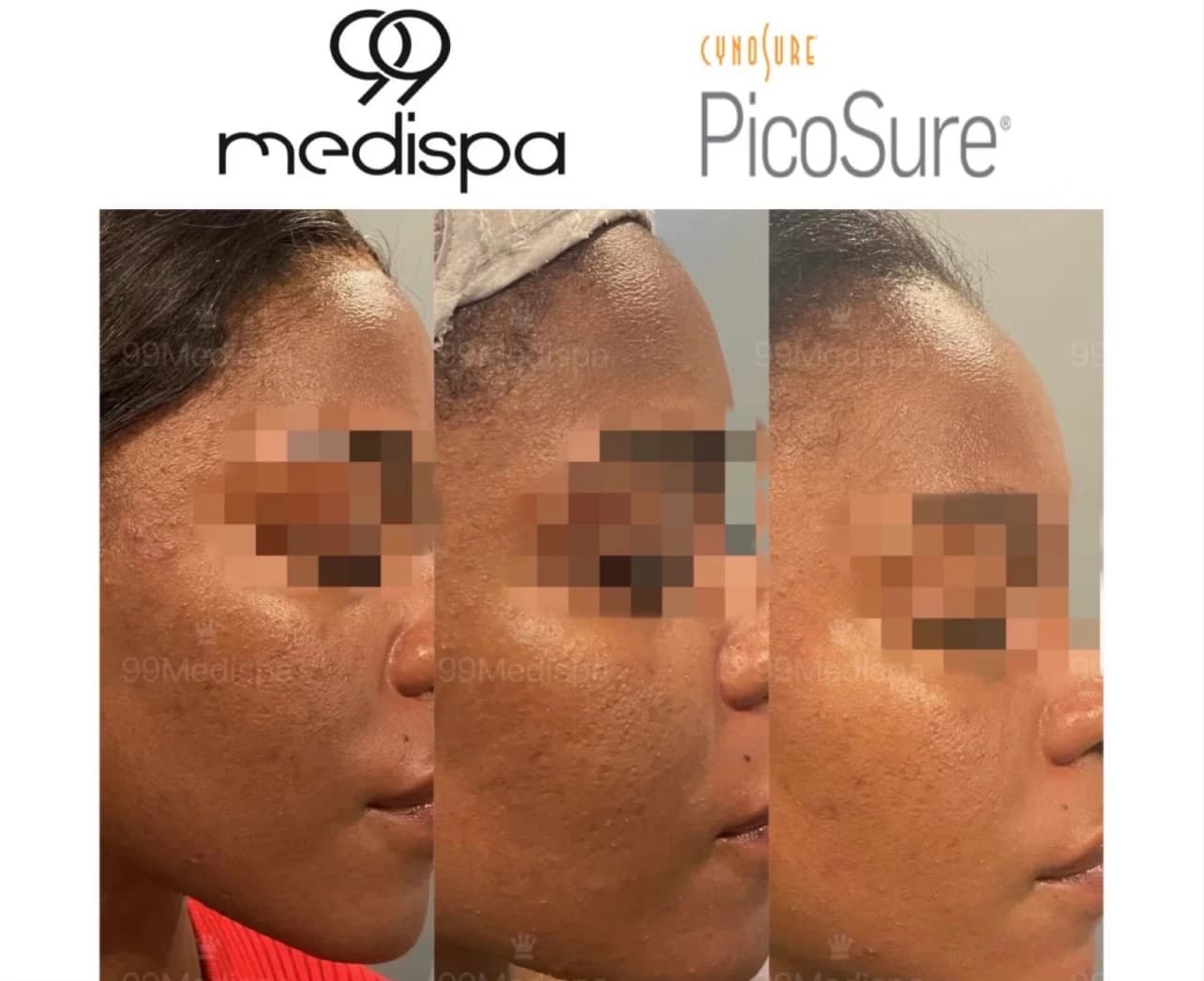 Picosure laser treatment result